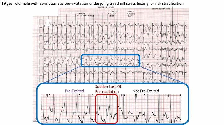 ECG in 60s - Wolff-Parkinson White