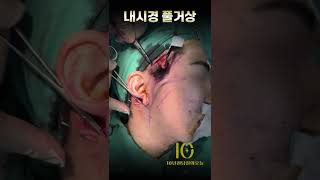 내시경 풀거상, 흉터 노출 없이 거상이 가능할까?  #내시경안면거상 #남성안면거상