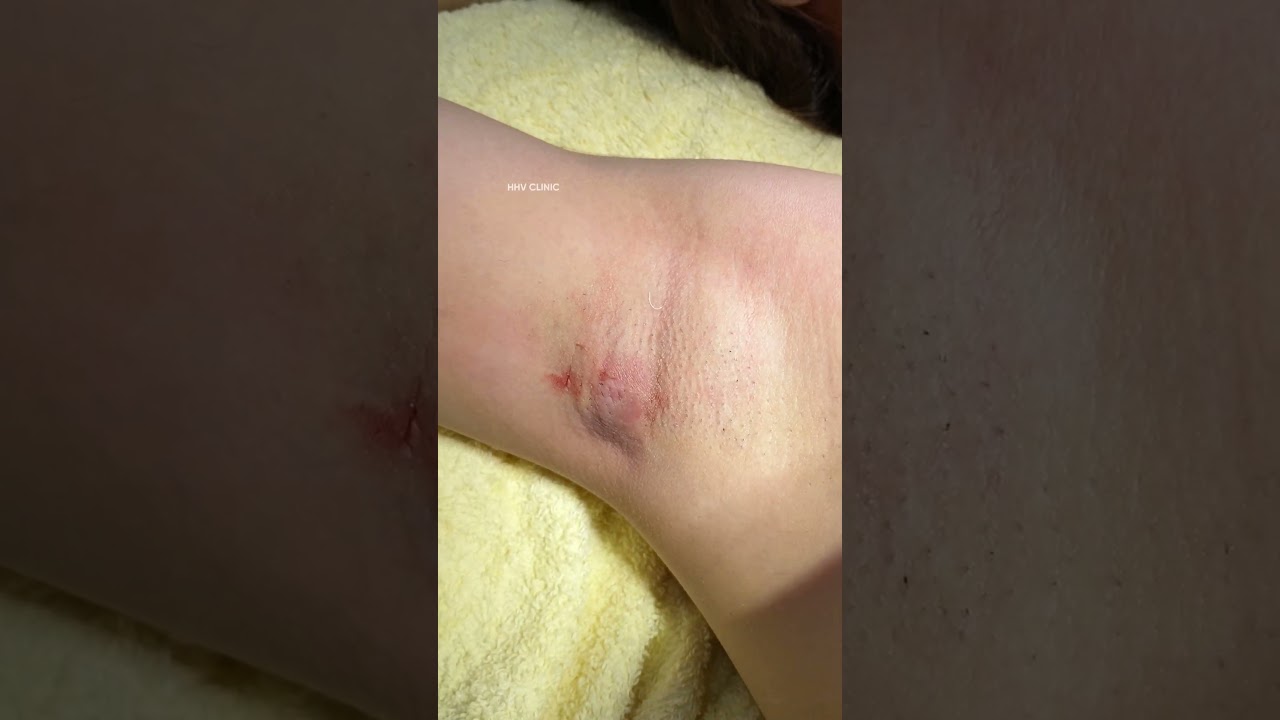 Nặn mụn áp xe ở nách - Tại phòng khám HHV Clinic.