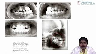 Epidemiology of Malocclusion