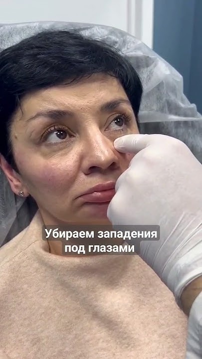 Убираем провалы и западения под глазами филлерами. - YouTube