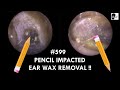 599 - PENCIL IMPACTED EAR WAX REMOVAL !!