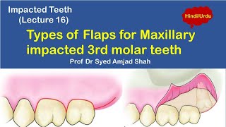 Types of flaps for Maxillary Impacted Third Molar | Oral & Maxillofacial Surgery | Syed Amjad Shah screenshot 4