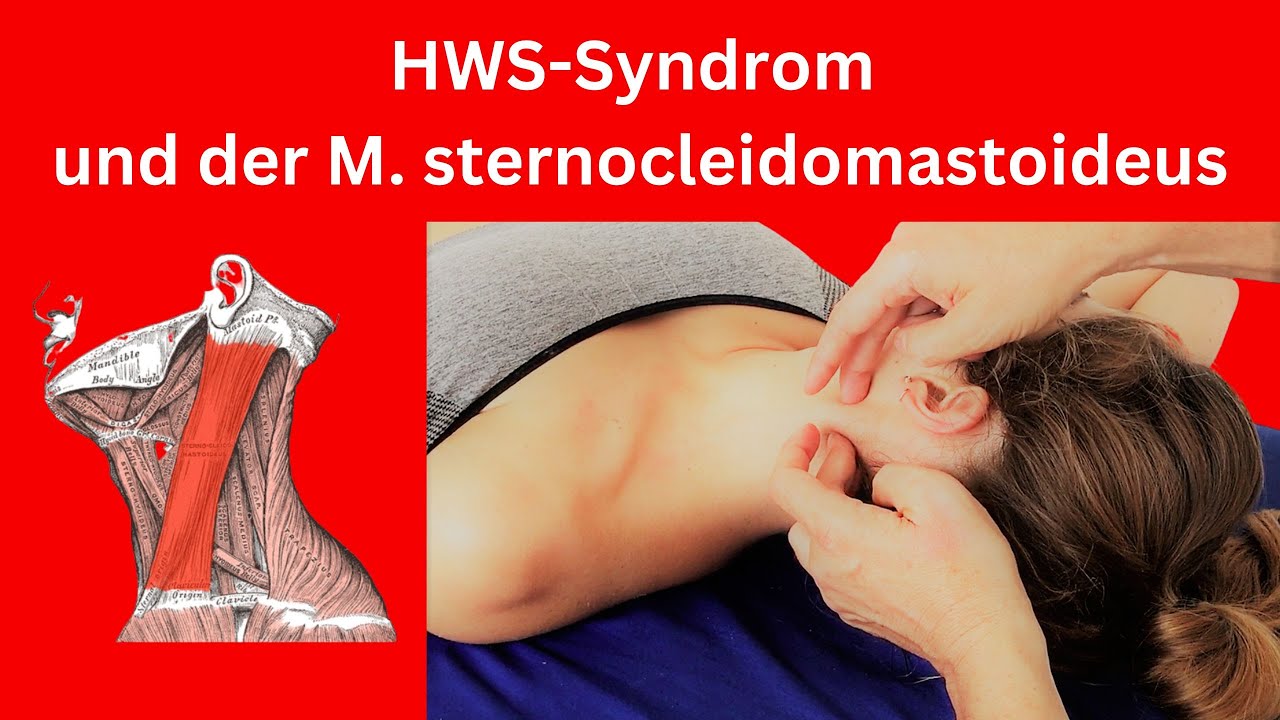 Behandlung des M. sternocleidomastoideus im Kontext des HWS-Syndroms