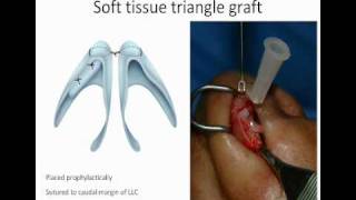 Advanced Closed Rhinoplasty Techniques: Soft Tissue Triangle Grafts screenshot 2