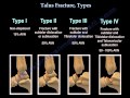 Talus Fracture Types - Everything You Need To Know - Dr. Nabil Ebraheim