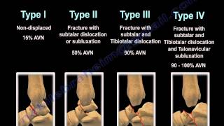 Talus Fracture Types - Everything You Need To Know - Dr. Nabil Ebraheim