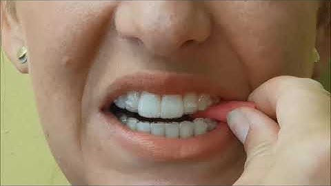 How to use your chewie with your Invisalign aligners #shorts