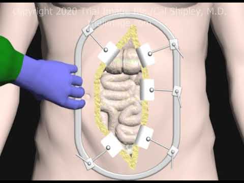 Lumbar Spinal Exposure using the Retroperitoneal Technique (ALIF Part 2) Animation Cal Shipley, M.D.