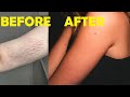 how to get rid of stretch marks on arms naturally