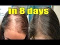 DOUBLE HAIR GROWTH AND STOP HAIR FALL Super long hair Growth in 8 days Get thick &amp; long hair