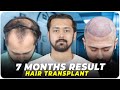 Hair transplant in india  best results  cost of hair transplant in india