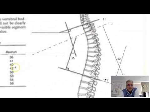 How to measure Kyphosis using x-rays - Click Subscribe button and Like if you enjoyed this