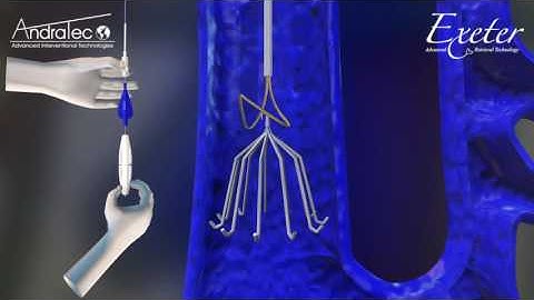 AndraTec Exeter Snare Vena Cava Filter Retrieval