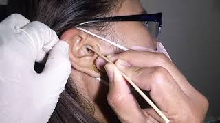 Dry Sheet of Earwax Removed from Woman&#39;s Ear | Or Is It A Skin?