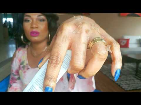Vidéo: Peeling De La Peau Sur Les Mains: Causes Et Traitement
