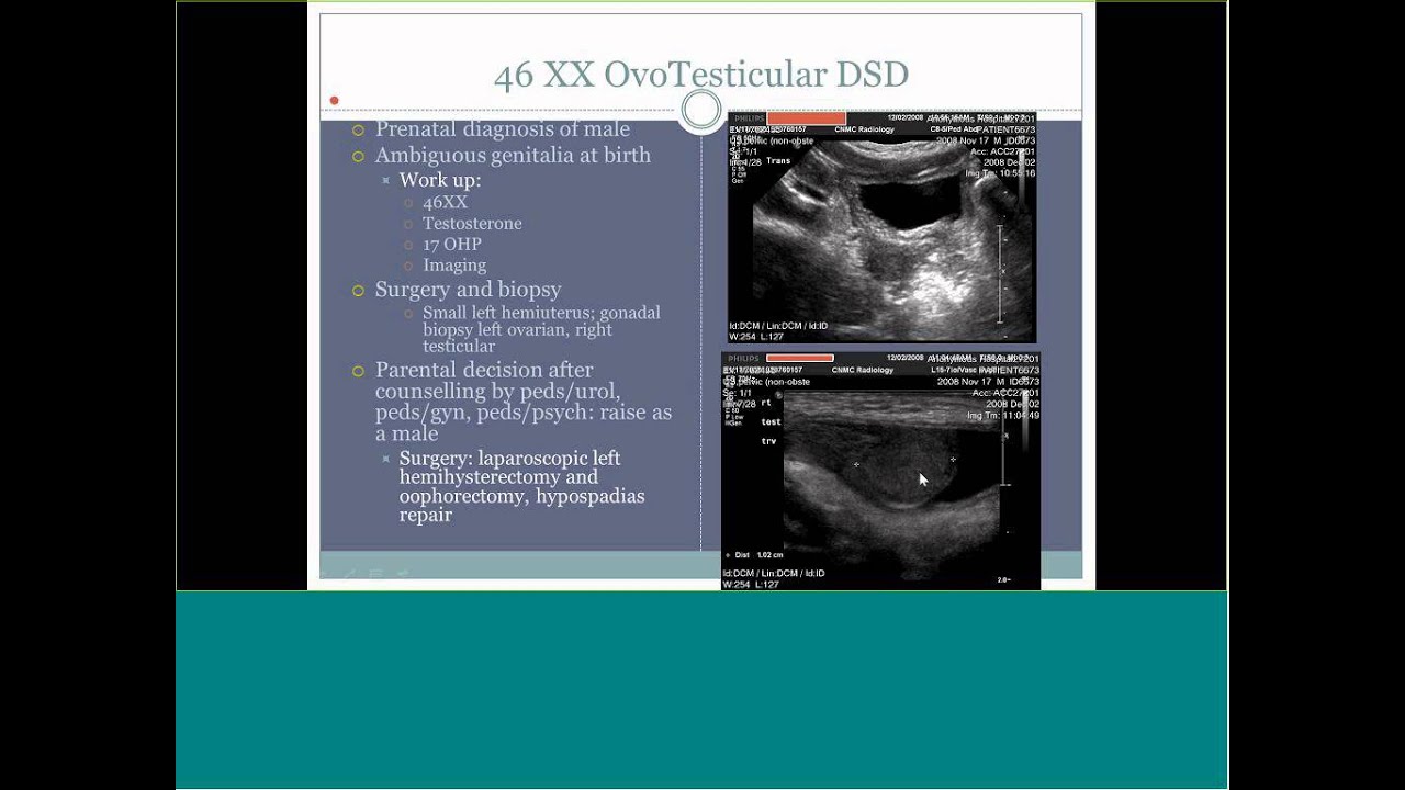 Ambiguous Genitalia Ultrasound