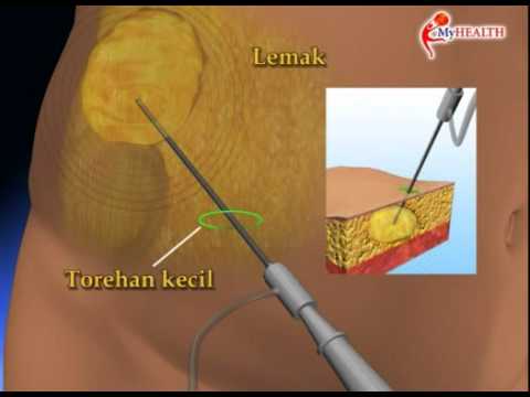 Video: Cara Operasi Menghilangkan Lemak Perut: 11 Langkah (dengan Gambar)