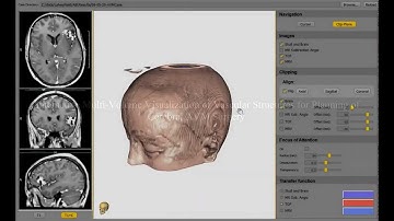 Interactive Multi-Volume Visualization of Vascular Structures for Planning of Cerebral AVM Surgery