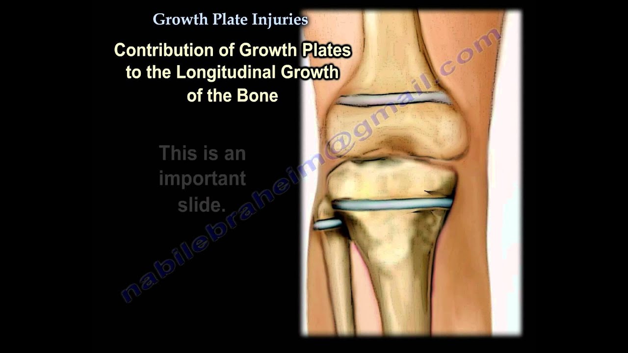 Growth Plate Injuries ,Overview- Everything You Need To Know - Dr. Nabil Eb...