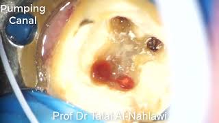 Exudate fom root canal Prof Dr Talal Al-Nahlawi د طلال النحلاوي