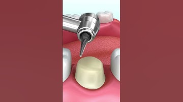 Series 21: Dán sứ Veneer là gì? Và nó khác gì với bọc răng sứ? #veneers