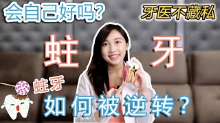 蛀牙竟然可以自愈?! 牙医所学秘密大公开！預防蛀牙的方法 l 如何让蛀牙消失？