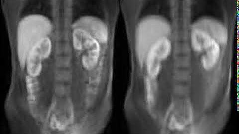 kidney image sequence stabilisation using Dynamic Mode Decomposition