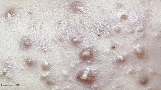 Milia, Big Cystic Acne Blackheads Extraction Whiteheads Removal #Part 02