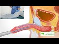 Catheterization with indwelling catheter (Man)