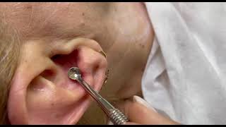 Ear cleaning. How does a beautician clean the ear كيف ينظف خبير التجميل الاذن؟