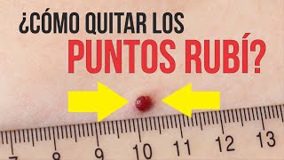 PUNTOS RUBÍ (NEVUS RUBÍ) 🔴 ¿Cómo ELIMINAR RÁPIDAMENTE? 💋 Eterna Juventud Medical Estetic Center