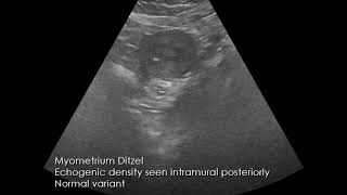 CASE 977 myometrial Ditzel @educationalradiologychanne9079