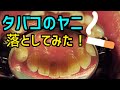 タバコのヤニを落としてみた！Real Dental ASMR