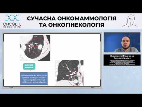 Можливість сучасної діагностики раку легень | Вебінар