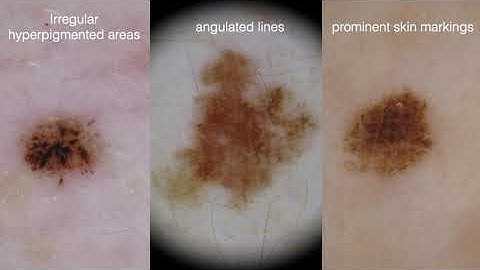 New melanoma structures  - Dr. Aimillios Lallas