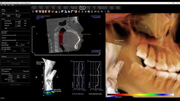 Invivo 기본교육 영상 - Airway Tab