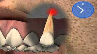 Root Tip Removal