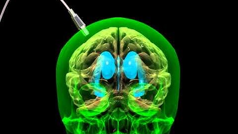 Brain Shunt Insertion Animation