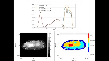 Extremely dense breast:  Iterative unsupervised machine learning segmentation detailed demonstration