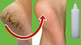 Permanently Remove Cracked Heels At Home Naturally - How To Remove Cracked Heels naturally at home screenshot 2