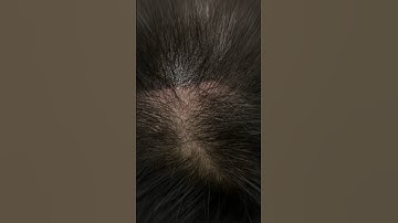 Anh chị nào tóc thưa xem ngay và luôn #reviewxămtóc #vnscalp #scalpvn #TuấnOri