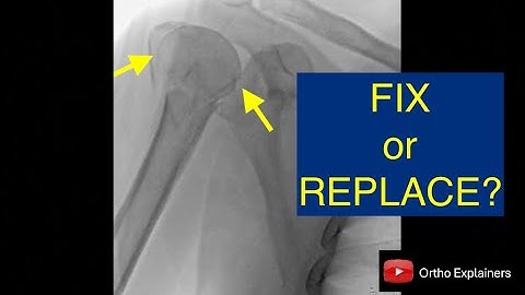 Is this proximal humerus fracture worth fixing?