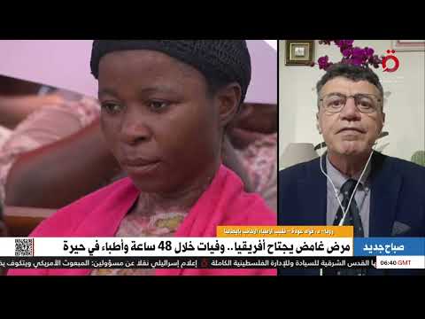 خطورته في النزيف د فؤاد عودة نقيب الأطباء الأجانب بإيطاليا يكشف أسباب غموض المرض المنتشر في الكونغو