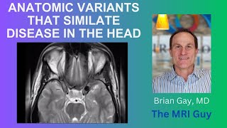 Anatomic variants in the head that simulate disease. Part 1.