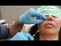 نحوه ی تزریق فیلر خط خنده ویزه پزشکان Nasolabial Fold Filler Injection Training By Dr Mohamad Omid نحوه ی تزریق فیلر خط خنده ویزه پزشکان Nasolabial Fold Filler Injection Training By Dr Mohamad Omid