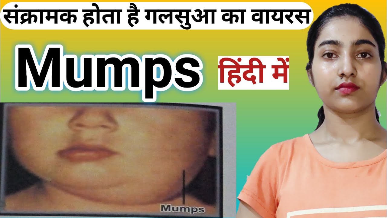 Mumps disease in hindi Causes and risk factorsSymptomsDiagnosis