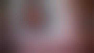 Pupil Expansion Procedure using Malyugin Ring 2.0 From MST