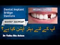 Denture, Dental Bridge or Dental Implant for missing tooth and its cost/price. By Dr Talha Bin Aslam