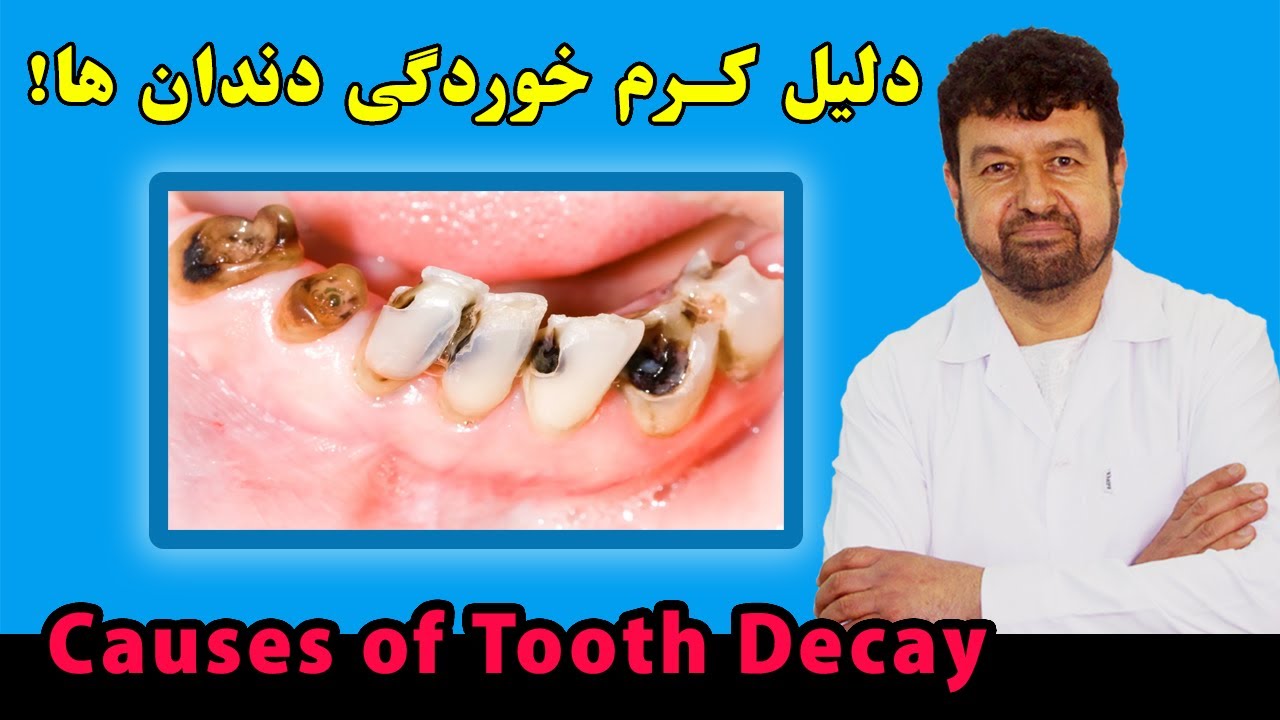 دلیل کرم خوردگی دندان ها چیست؟ 🩸 داکترستان
